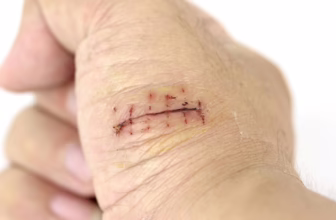 Wound on hand with stitches