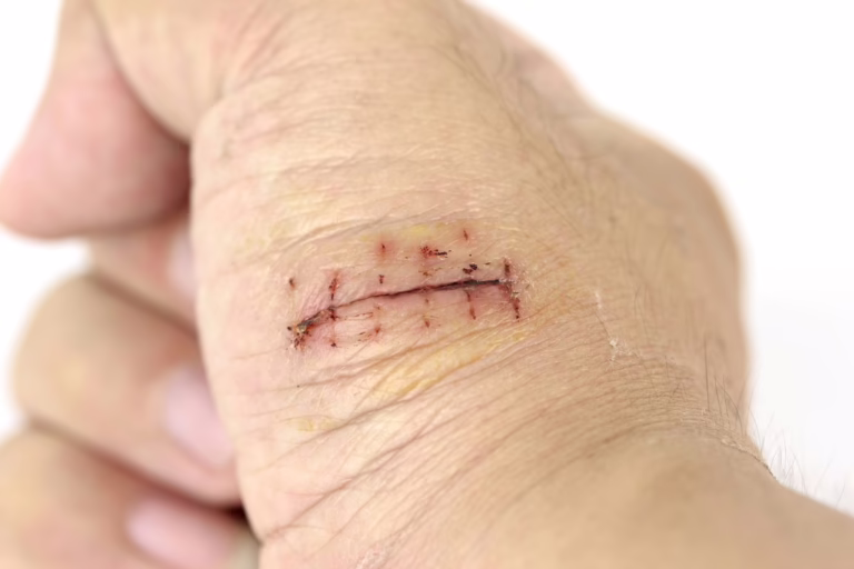 Wound on hand with stitches