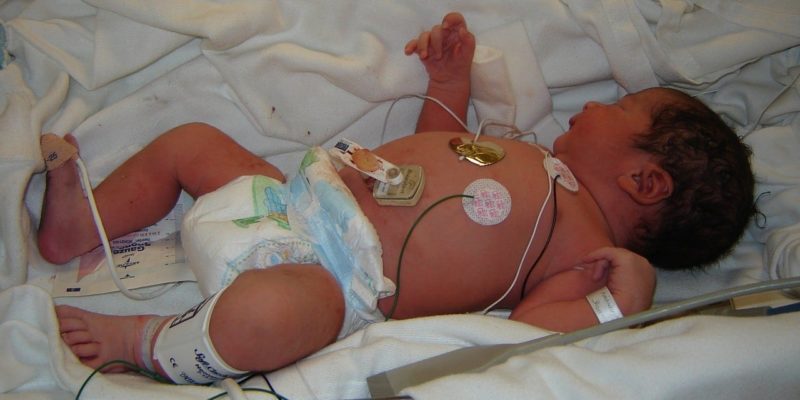 The Link Between Birth Complications and Autism