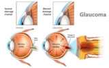 Glaucoma Empowerment Guide: Symptoms, Causes, and Treatment